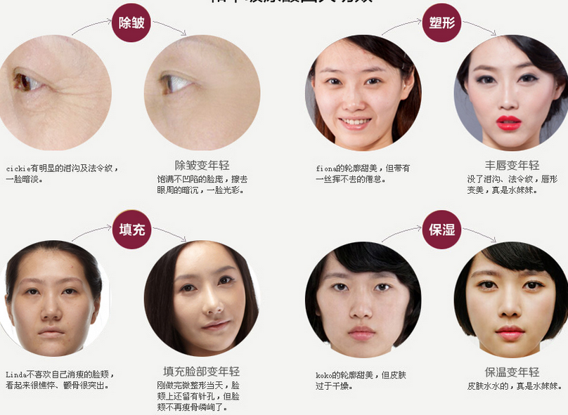 玻尿酸隆鼻效果