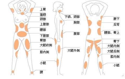 吸脂部位图
