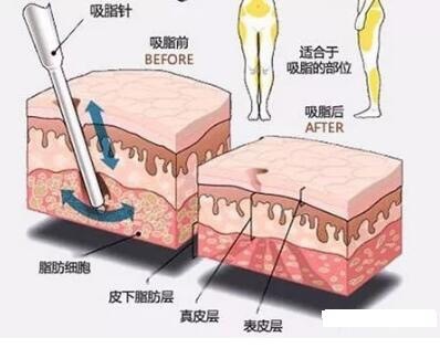 吸脂手术