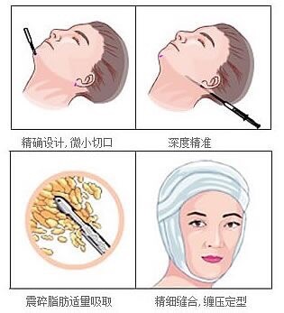 吸脂