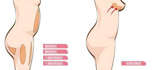 自体知道隆胸