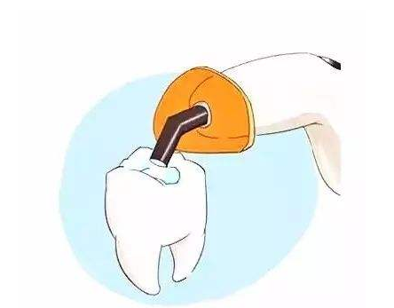 补牙齿一般多少钱 