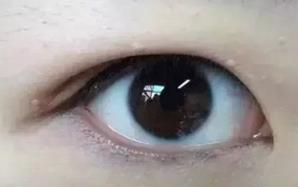 什么是肿泡眼