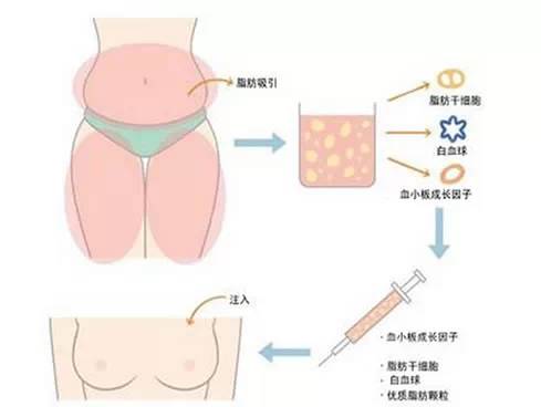 自体脂肪丰胸手术的过程是怎样的？瘦的人可以做吗？