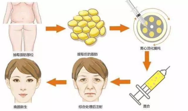 关于自体脂肪填充的五个问题
