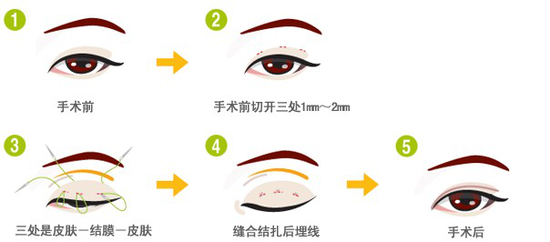 你适合做埋线双眼皮吗？