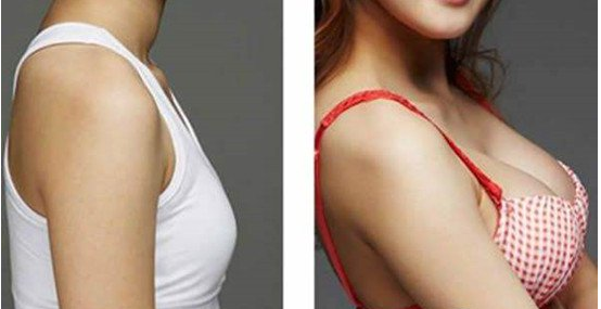 广州韩妃做假体隆胸怎么样？娜绮丽隆胸多久变软啊？