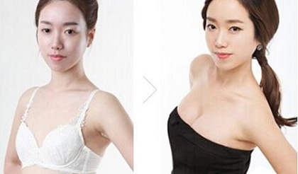 哈尔滨科美告诉你，隆胸安全吗？哪种隆胸方式比较安全？