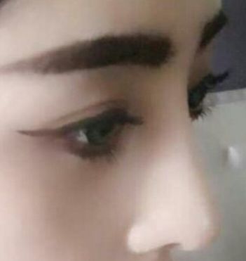鼻综合是否一劳永逸？这种手术的修复率是多少？