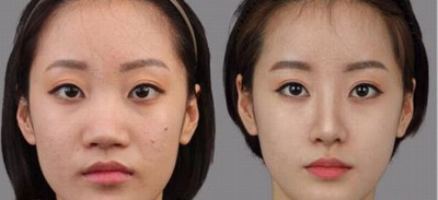 江州素美医院整形怎么样？江州素美杨迪做隆鼻多少钱？