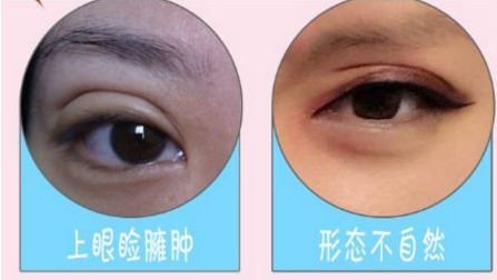 广州韩佳人告诉你双眼皮失败修复这两个时间段不可错过