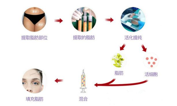 昆明美立方做自体脂肪填充多少钱？技术怎么样？