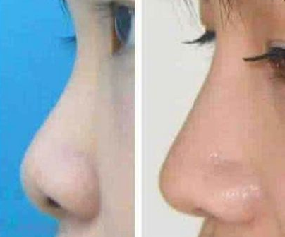 假体隆鼻手术的医院怎么选择？