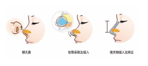 武汉朝天鼻矫正要多少钱？