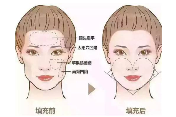 广州时光自体脂肪丰额头手术的效果如何？
