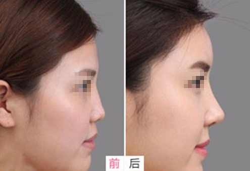 广州曙光整形美容医院鼻背整形手术价格的因素有哪些