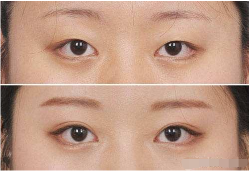 杭州格莱美全切双眼皮术后如何护理？