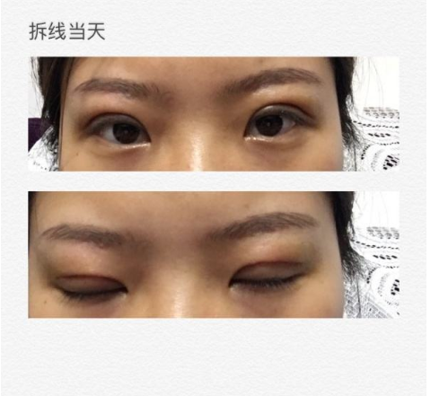 北京美莱做上睑下垂矫正常用什么方法?