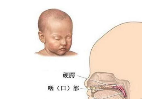 江州哪家医院唇裂修复手术好？江州圣丹福怎么样？