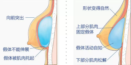 有哪些因素会影响到丰胸的费用呢？
