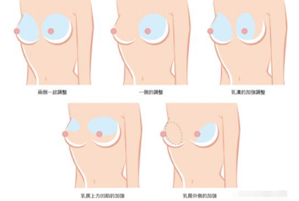 武汉美之仁假体丰胸有哪些优势？