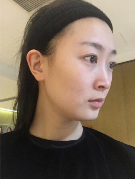 广州美贝尔整形医院做面部抽脂瘦脸手术后会反弹吗？