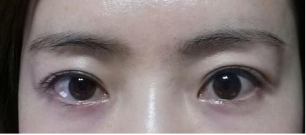 杭州时光做双眼皮修复多少钱？失败的双眼皮手术能修复吗？
