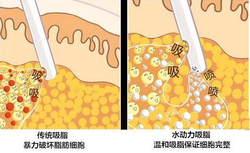 广州做全身抽脂有副作用吗?
