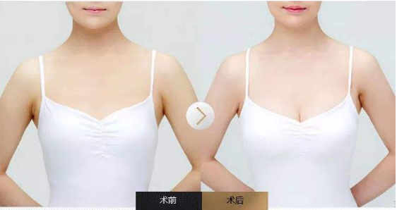 惠州自体脂肪丰胸能维持多久呢