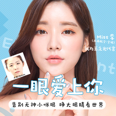 【眼整形】 江州埋线双眼皮 无痕翘睫开眼角上睑下垂矫正 恢复后宛若天生
