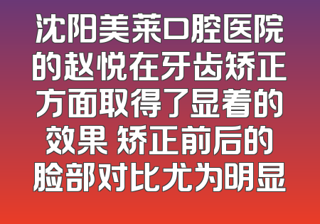 沈阳美莱口腔医院的赵悦在牙齿矫正方面取得了显着的效果 矫正前后的脸部对比尤为明显